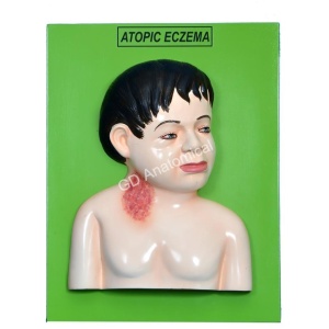 Atopic Eczema Model