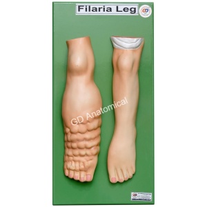 Filariasis Leg Model