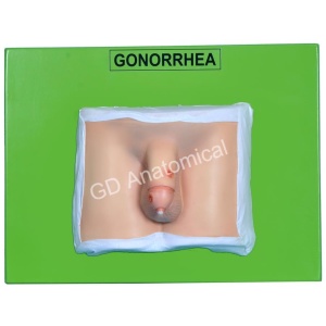 Gonorrhea Model
