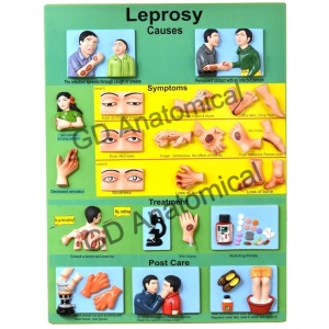 Leprosy