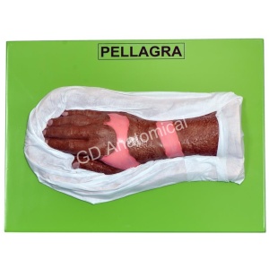 Pellagra Model
