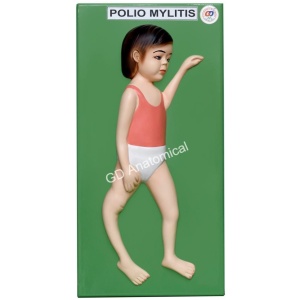 Poliomyelitis Model
