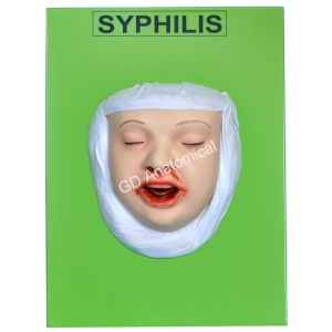 Syphilis Model
