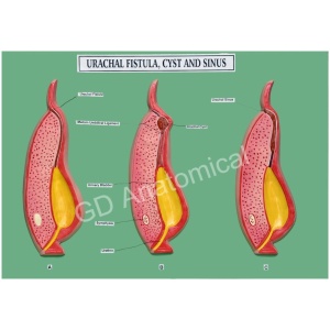 Urachal Fistula, Cyst And Sinus Model