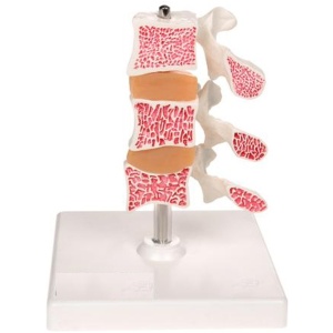 Deluxe Osteoporosis Anatomy Model