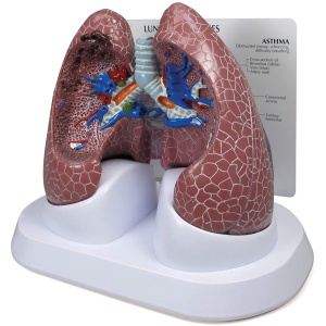 Diseased Lung Anatomy Model