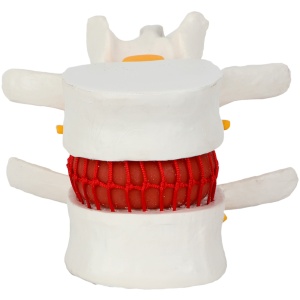 Human Lumbar Herniating Disc Demonstration Anatomy Model