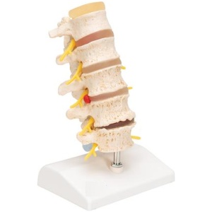 Stages Of Disc Prolapse and Vertebral Degeneration Anatomy Model